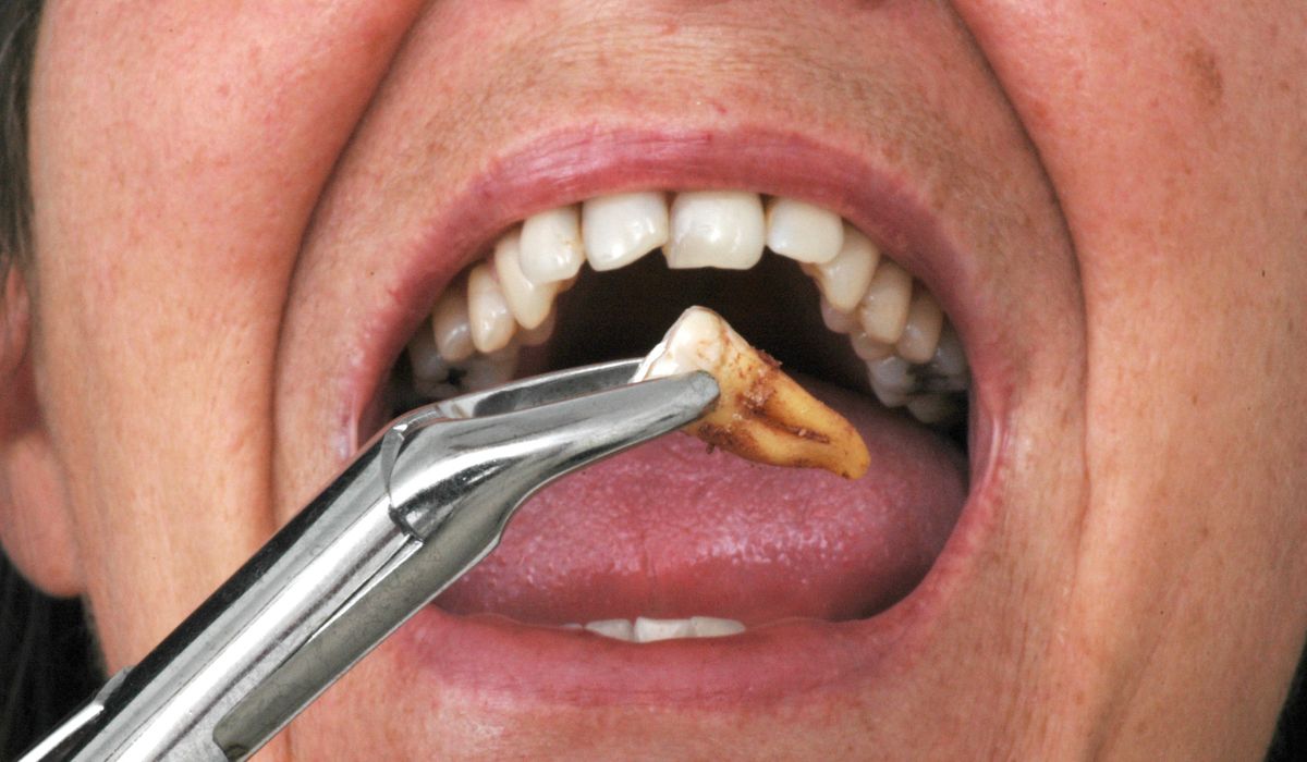 Tooth Extraction