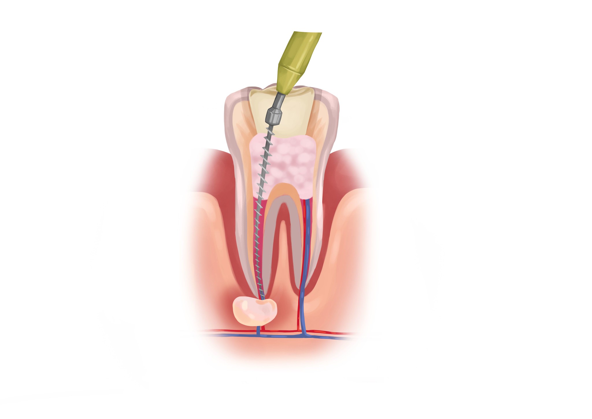 Root Canal Procedure